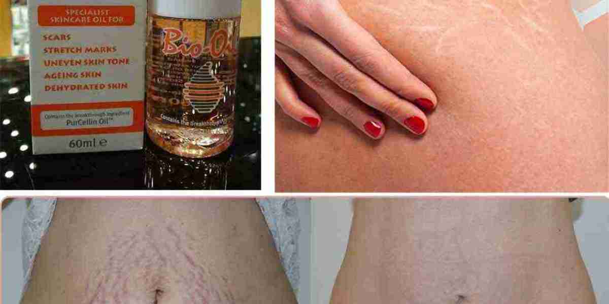 Bio-Oil for Scars and Stretch Marks