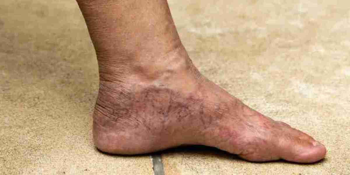 Conquering Varicose Veins: Tips for Relief and Prevention
