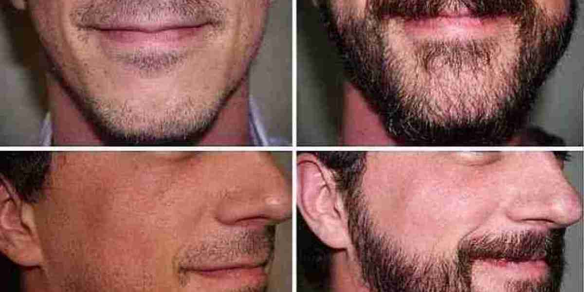 Hair Transplant for Beard Restoration: Popular Trend in Dubai