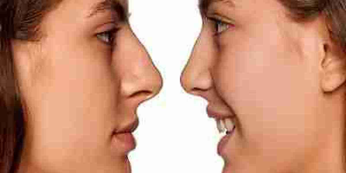 What are the Different Types of Rhinoplasty Procedures in Dubai?