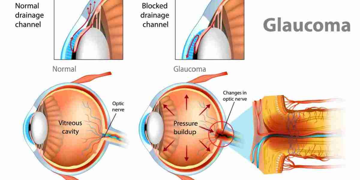 Glaucoma Market Growth Overview & Industry Forecast Report 2033