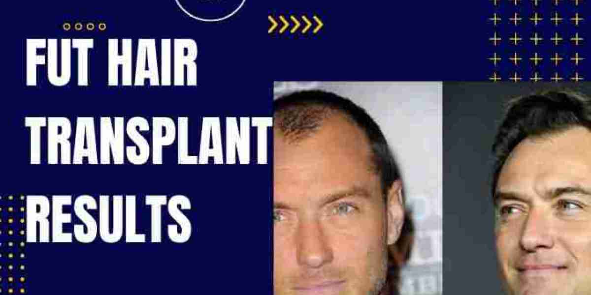 The Incredible Impact of FUT Hair Transplant Result