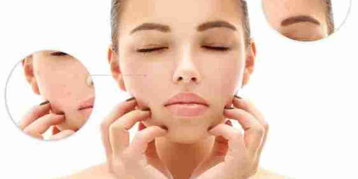 Unleash Your Skin’s Full Potential with Acne Scars Treatment