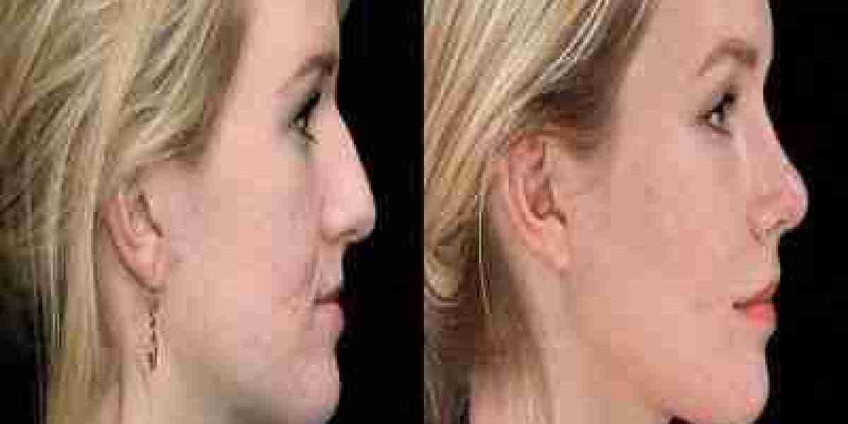 5 Reasons Why Chin Augmentation in Dubai is the Perfect Solution for Facial Harmony