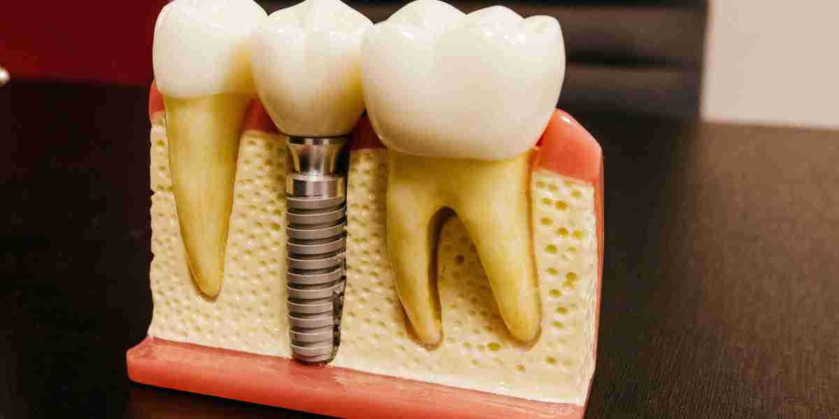 Dental Implants Dartford: Your Guide to a Perfect Smile