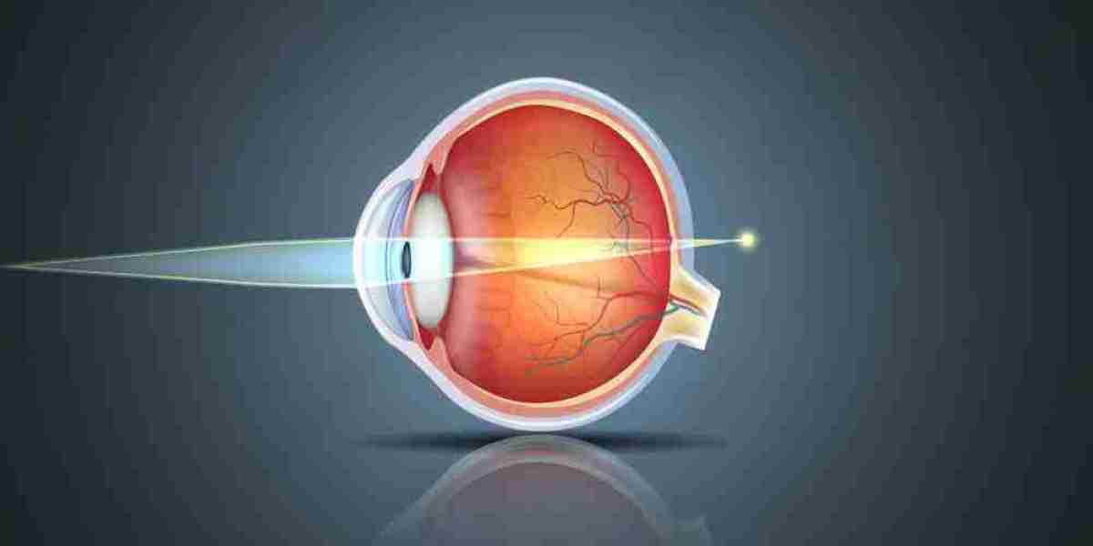 Hyperopia (Farsightedness): Effective Treatment Strategies