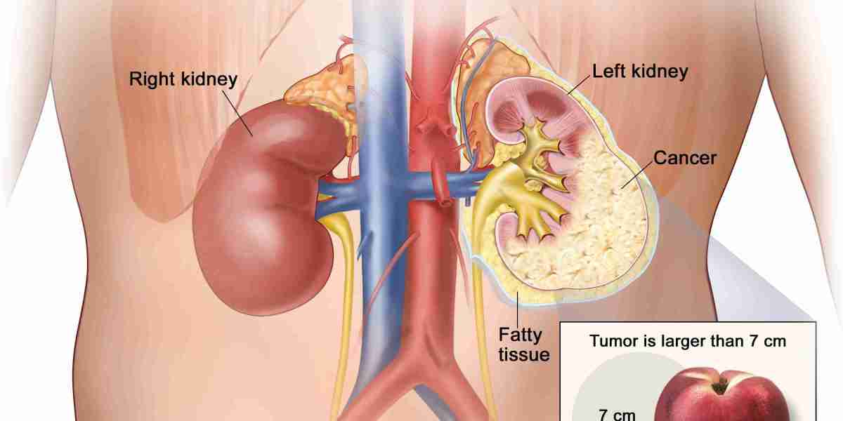 2024 Renal Cell Carcinoma Market | Report By 2034