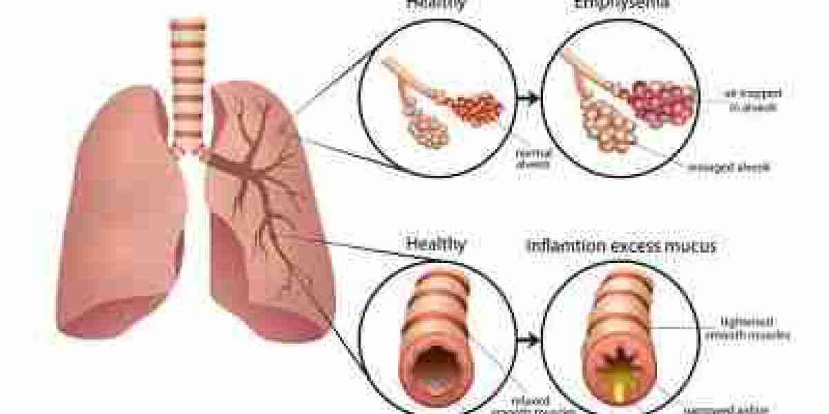 COPD Specialist in Rajasthan: Expert Care with Dr. Virendra Singh