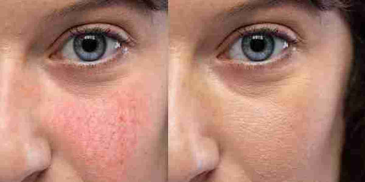 Is Facial Capillary Treatment in Dubai Painful?