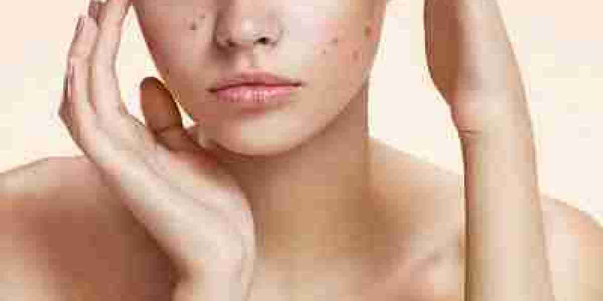 Potential Side Effects: Glutathione and Acne Flare-Ups