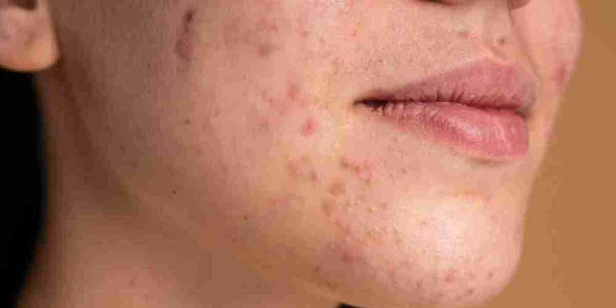 Is Homeopathic Treatment Effective for Acne Scars? Find Out Here