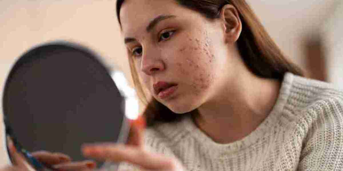 How Much Time Does Homeopathy Take to Cure Acne?