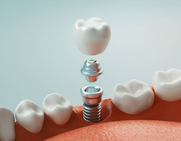 Dental Implants – Is this the best choice for you? | Davis and Engert Dentistry