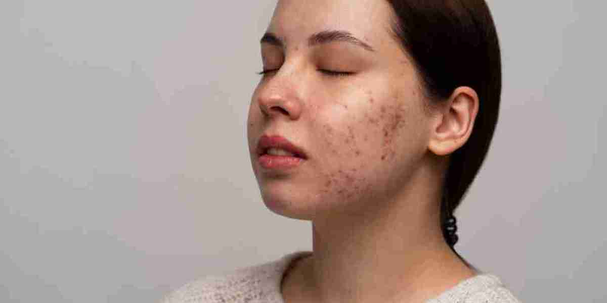 How Can Homeopathy Help Treat Acne at Dharma Homoeopathy?