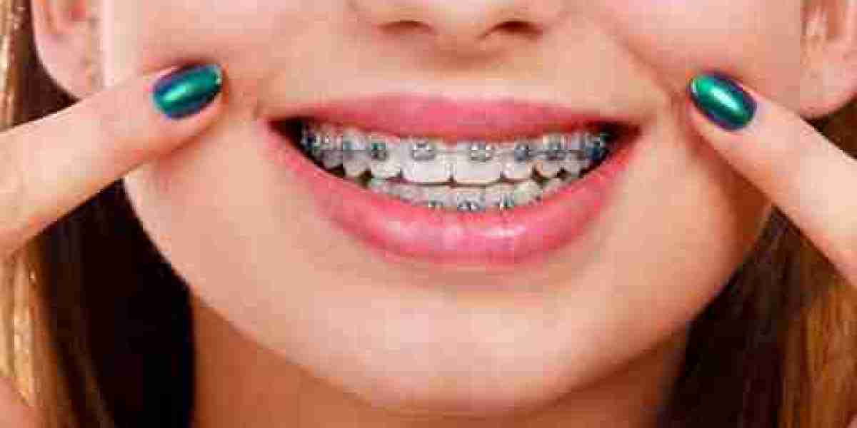 Title: Metal Braces for Kids: What Parents Need to Know