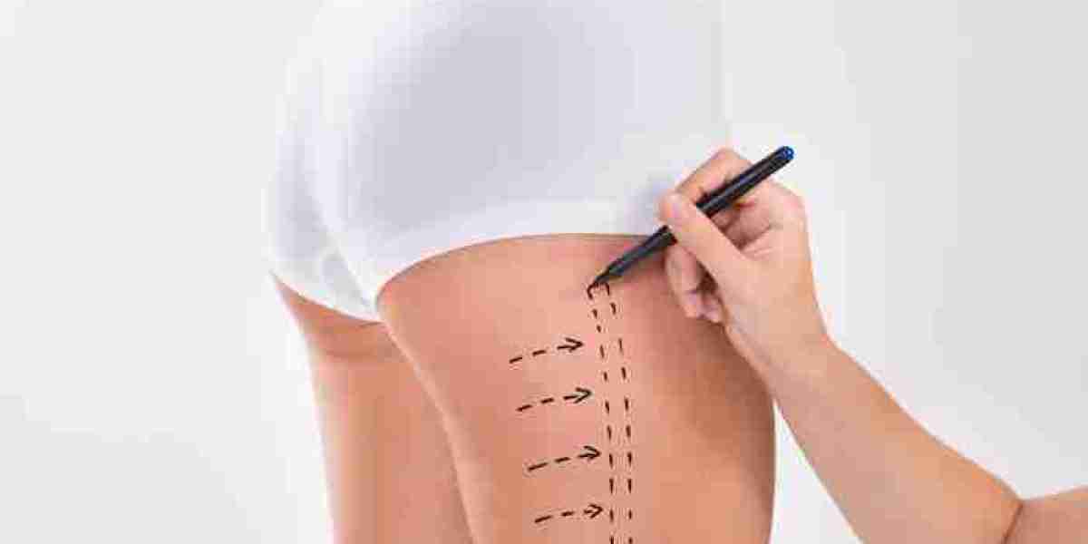 Liposuction for Outer Thighs in Dubai