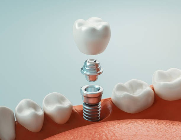 Dental Implants - Is this the best choice for you?