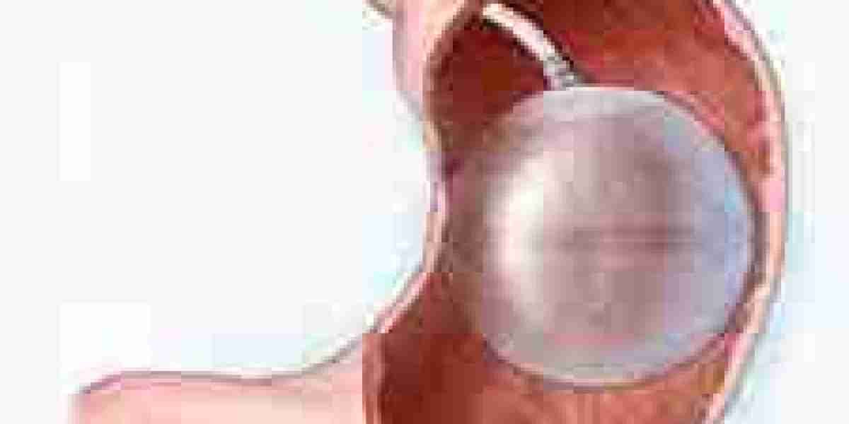 The Rise of Gastric Balloon Placement in Dubai: A Revolutionary Weight Loss Solution