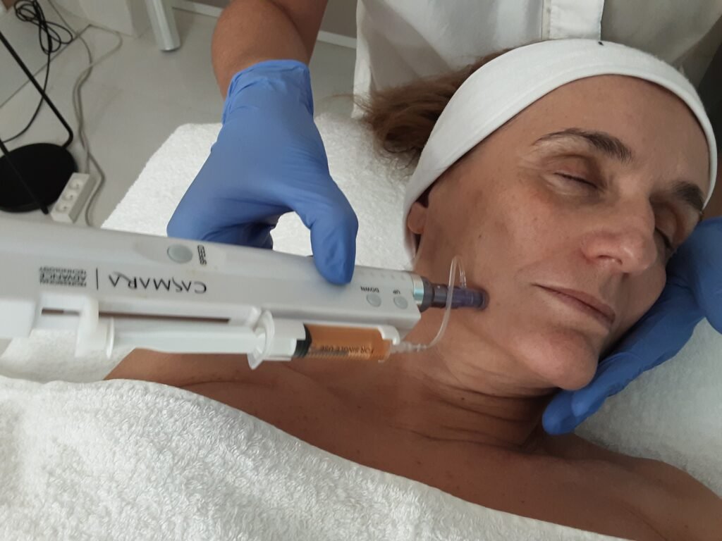 Tratamiento Facial con Dermapen en Alicante | El Mejor Facial para Piel Envejecida