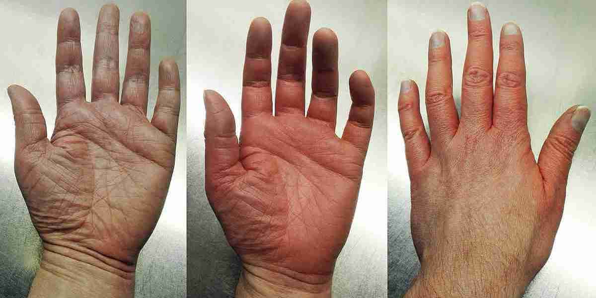 Erythromelalgia Treatment Market Report: Latest Industry Outlook & Current Trends 2023 to 2032