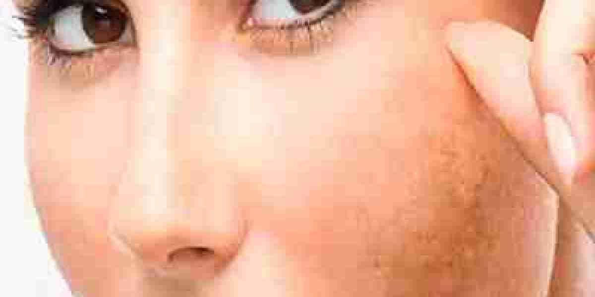 Effective Solutions for Melasma: What Dubai Has to Offer