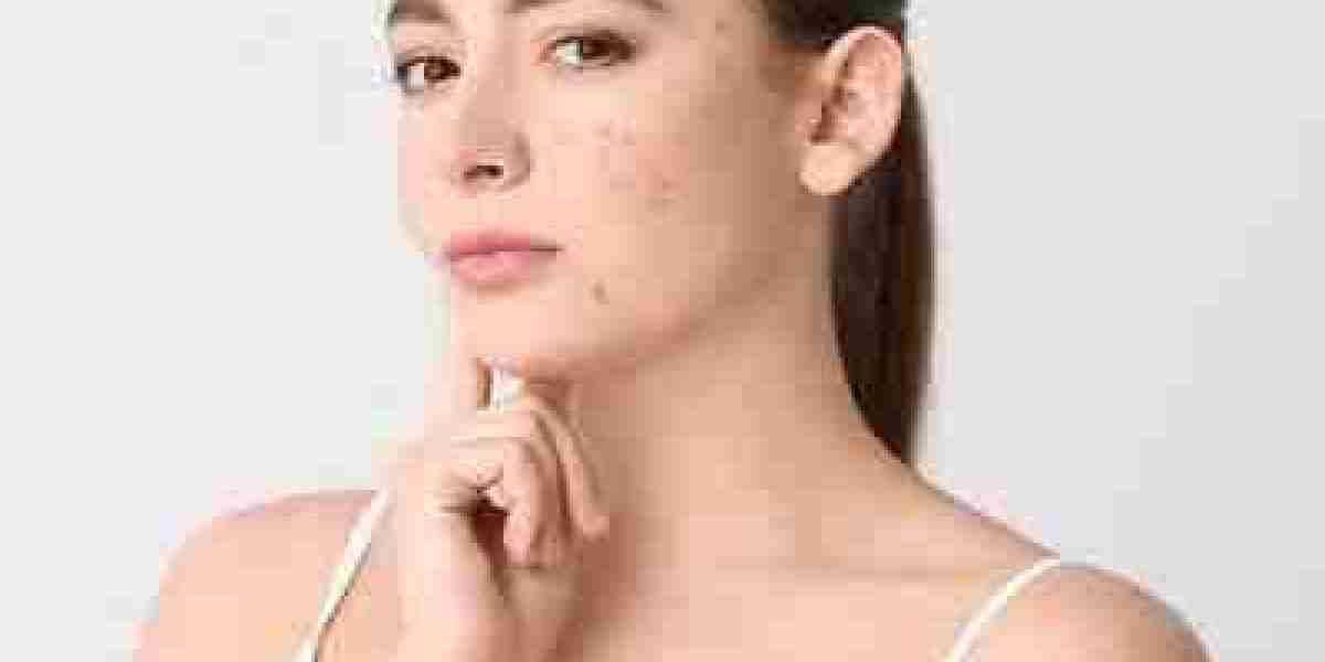 Revitalize Your Skin: Acne Scar Solutions