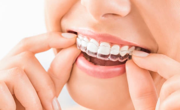 The Perks of Invisalign Over Traditional Braces – THE ORTHODONTIST & CO.