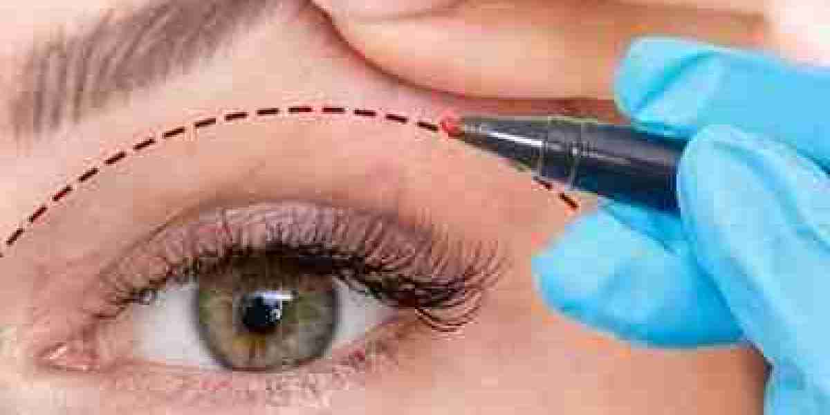 Common Myths About Eyelid Surgery in Islamabad