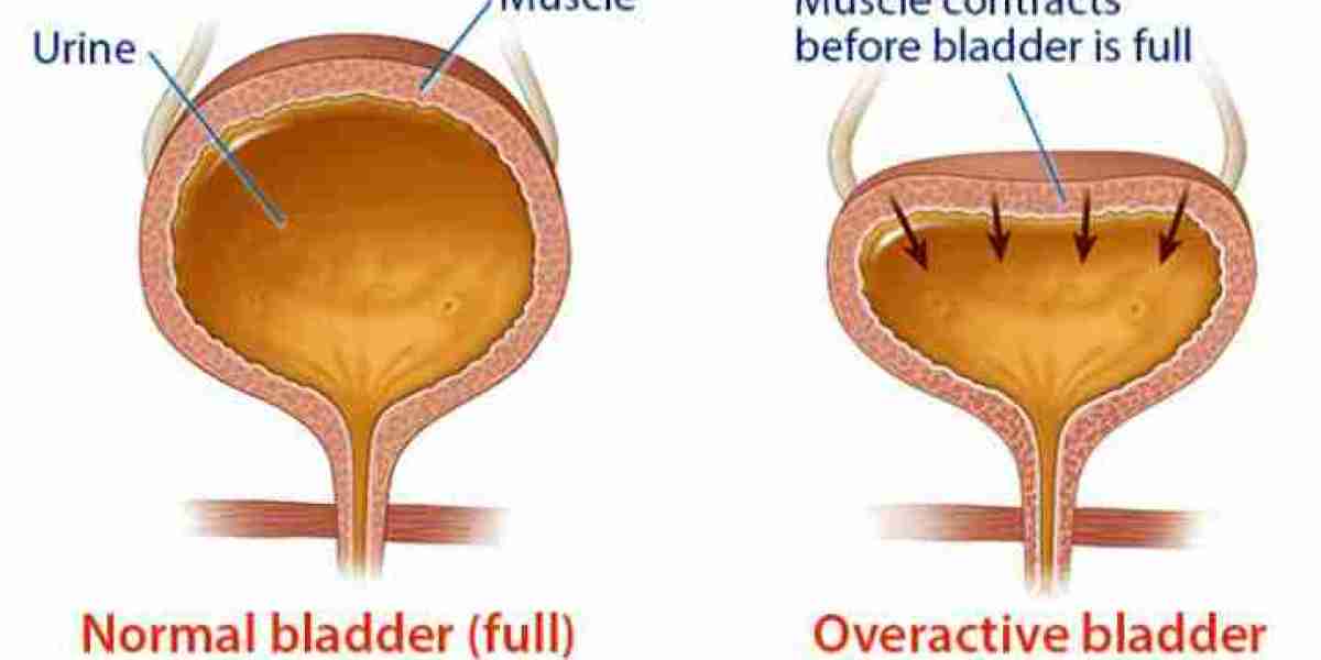 Overactive Bladder Market Size, 2024 Analysis, Industry Trends and Forecasts to 2034
