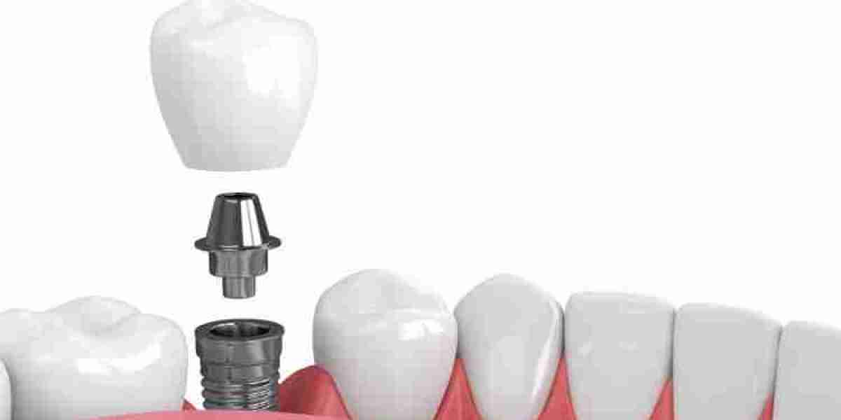 Single Tooth Dental Implants: A Comprehensive Guide