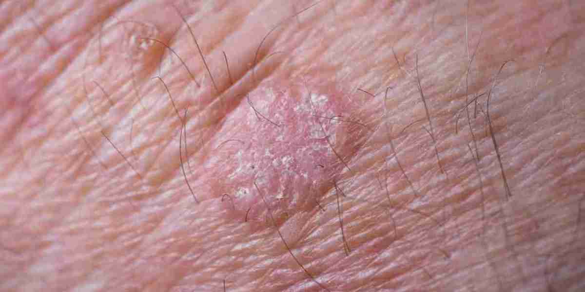 Actinic Keratosis Market Growth, Share, Opportunities & Competitive Analysis, 2024 – 2032