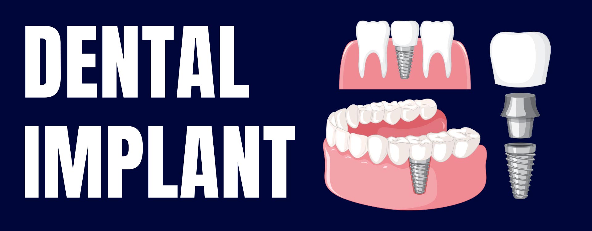 Dental İmplant Nedir - Diş İmplantı İstanbul - Aliadent