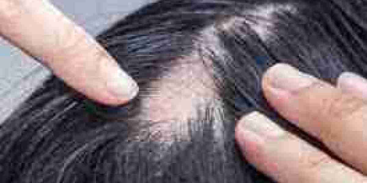 Alopecia Market looks to expand its size in Overseas Market
