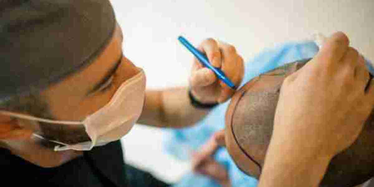 Addressing Common Concerns: Hair Transplant FAQs for Riyadh Patients