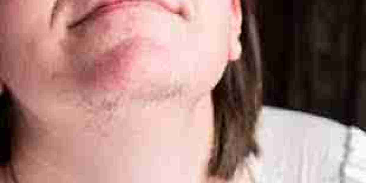 Hirsutism Market Growth Trends Analysis and Dynamic Demand, Forecast 2024 to 2032