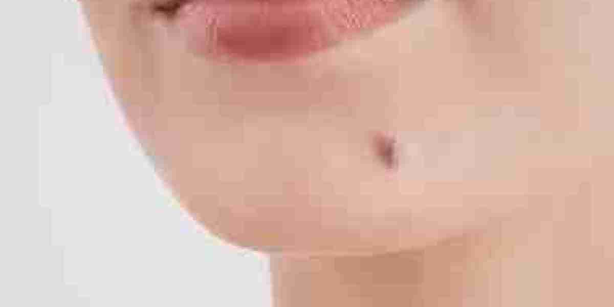 Dubai's Top Treatments: Get Expert Advice on Mole Removal