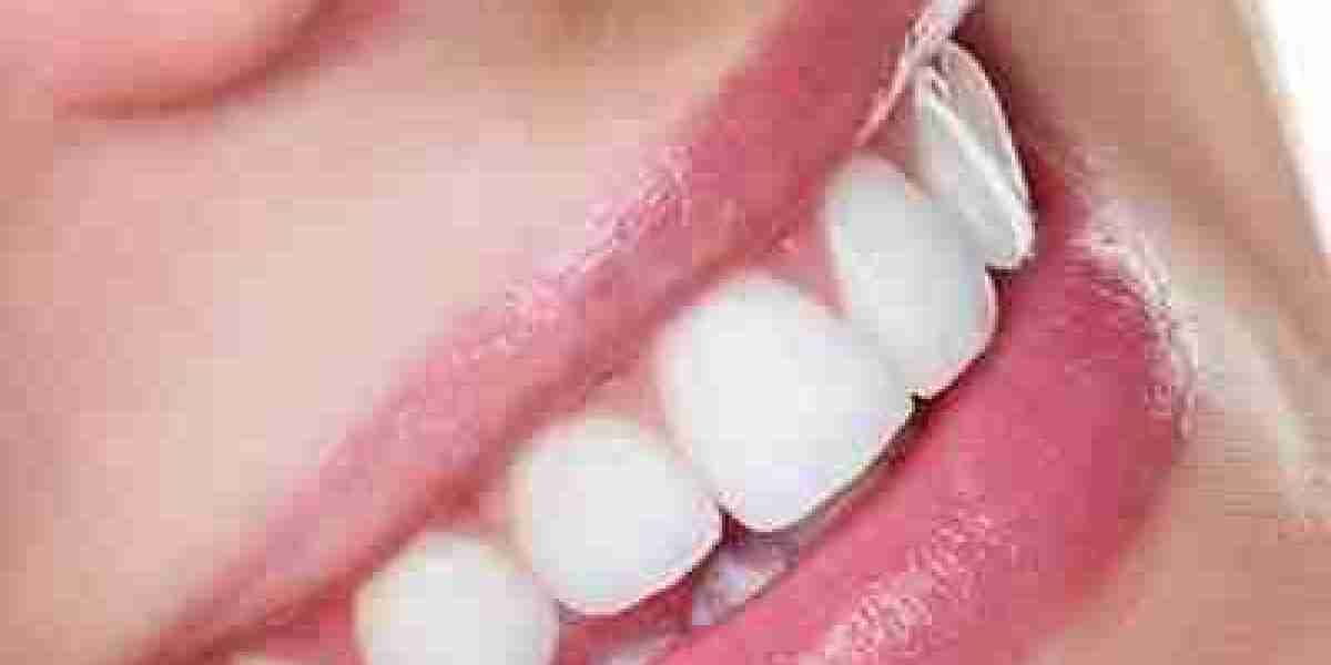 The Secrets Behind Dubai’s Most Effective Teeth Whitening Treatments