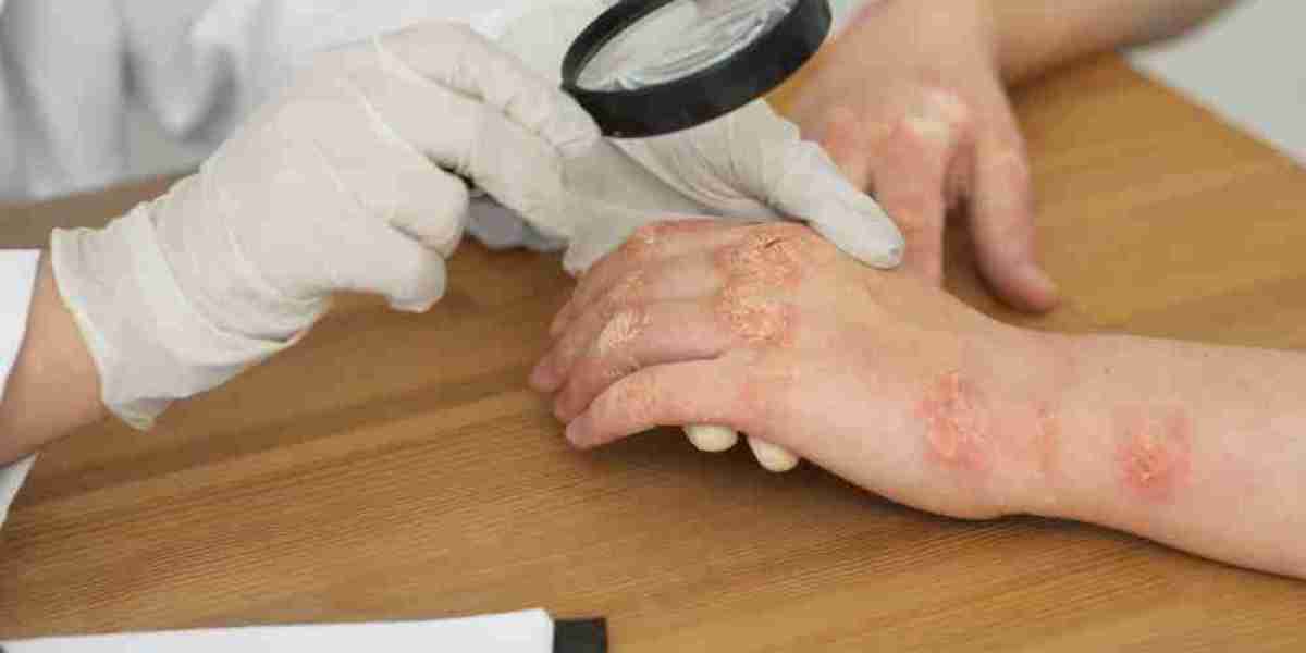 Common Fungal Infections