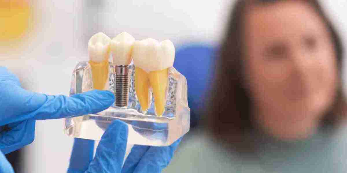 How to Find the Best Dentist for Implants in Delhi