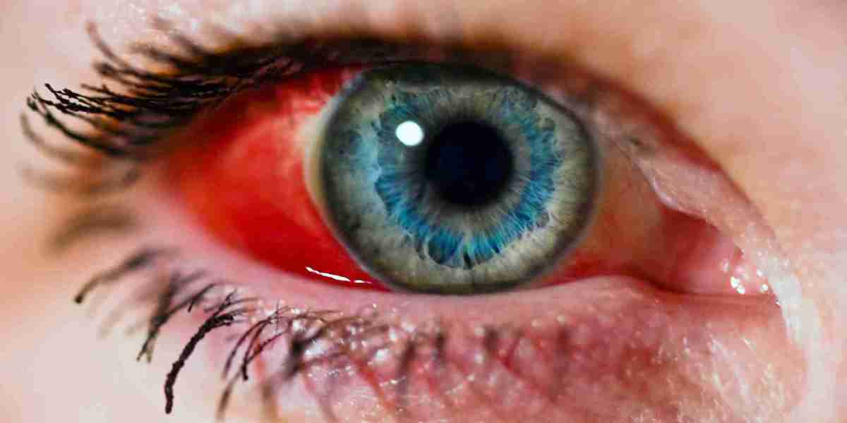 Blood in Eyes: Is It Alarming If Your Eye’s White Has Turned Scary Red?