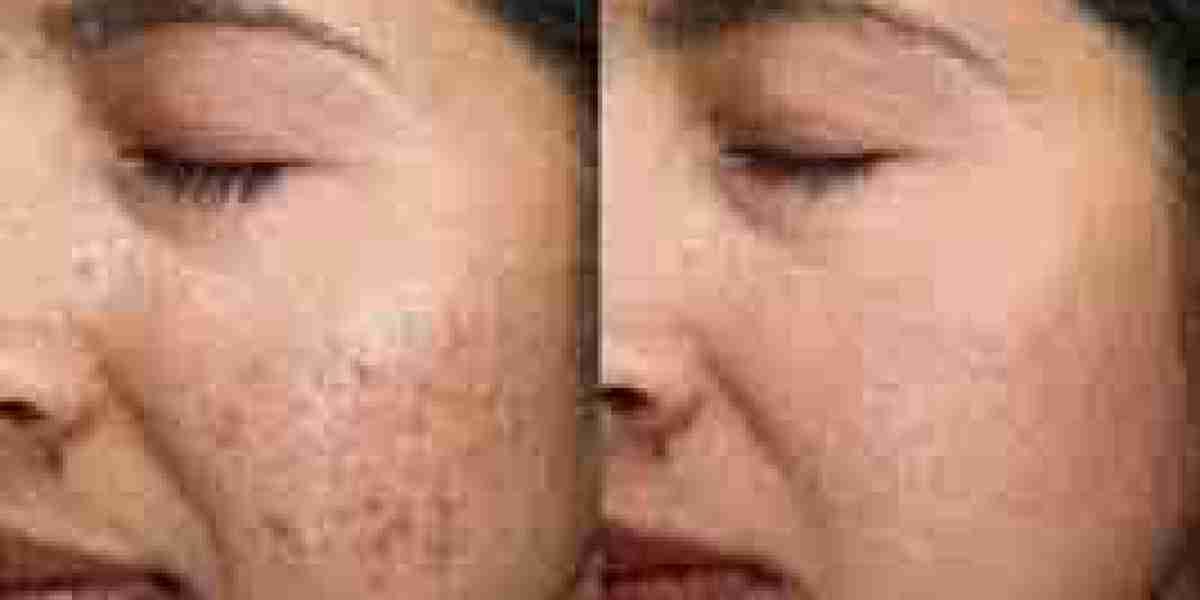 Exploring Low-Cost Acne Treatment Options: Effective Solutions That Work