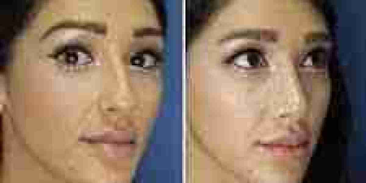 Rhinoplasty Dubai: Enhance Your Facial Harmony