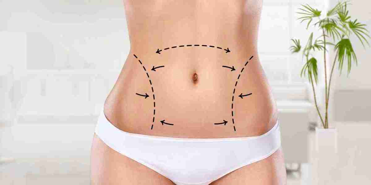 Liposuction for Different Body Areas: What to Know in Dubai