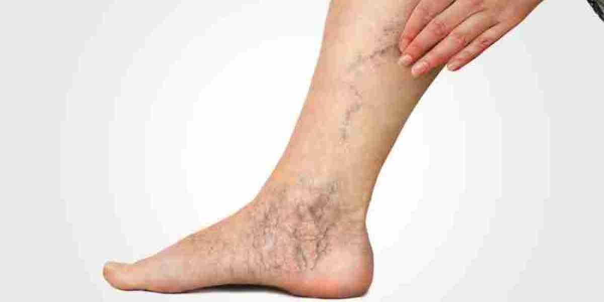 Lifestyle Changes and Self-Care Tips to Prevent Varicose Veins