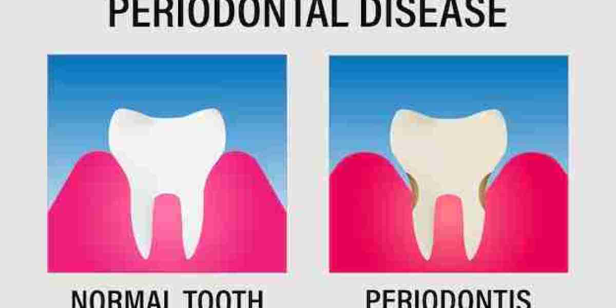 Understanding Periodontal Disease Treatment: A Comprehensive Guide