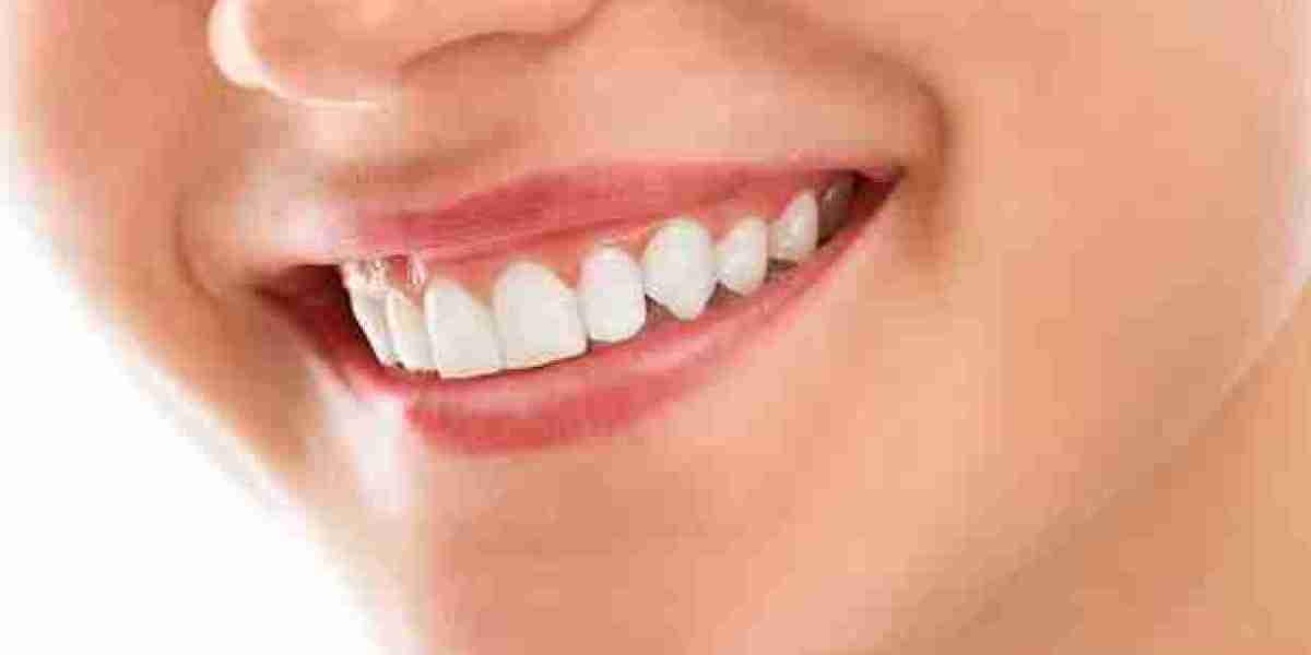 What You Need to Know About Teeth Whitening Prices in Singapore