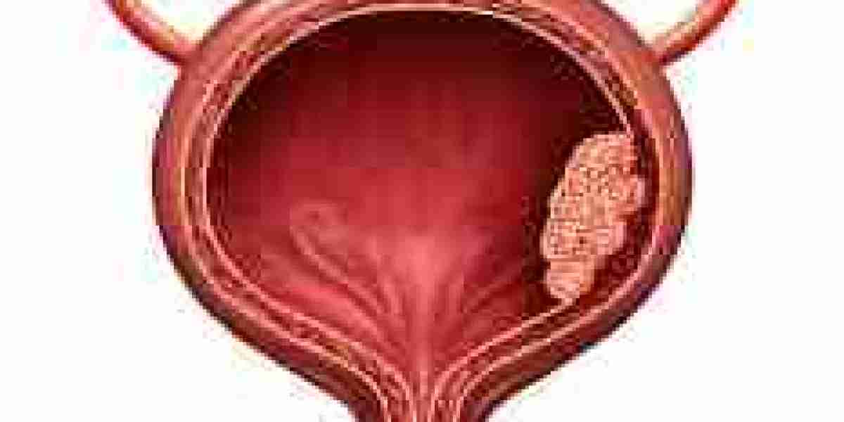 A Holistic Approach to Bladder Cancer Treatment in Jaipur