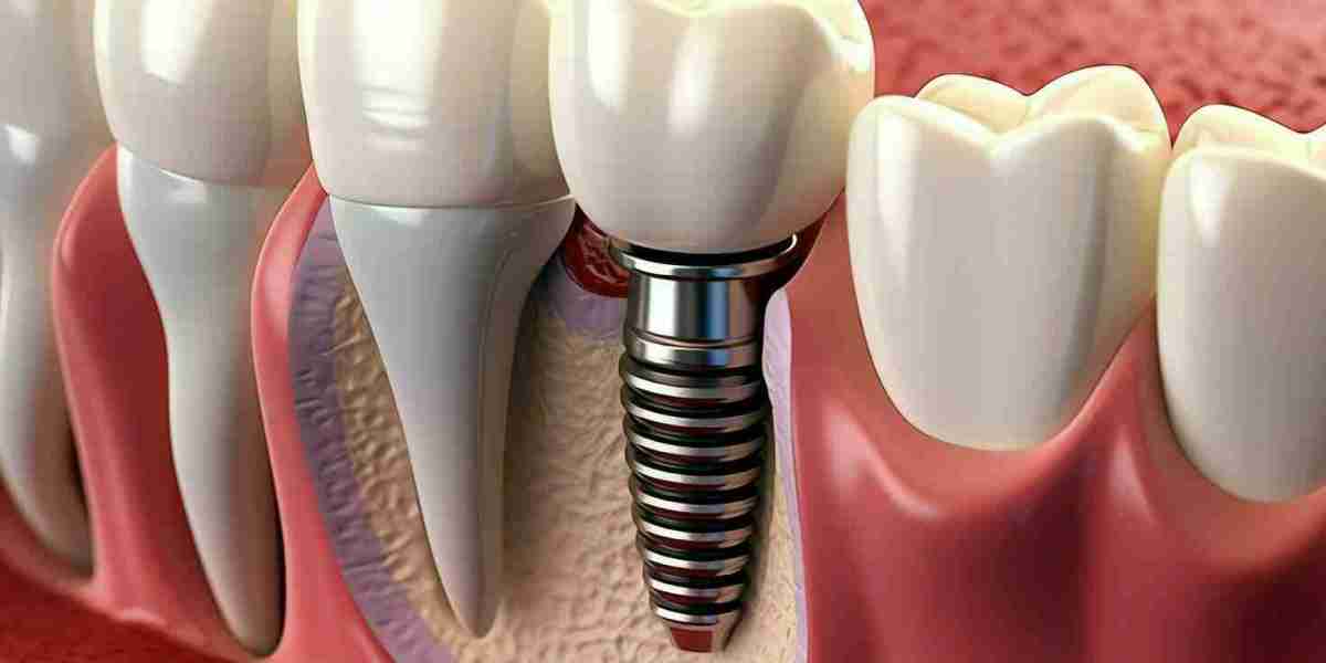 A Comprehensive Guide to Dental Implants: Restoring Your Smile with Confidence