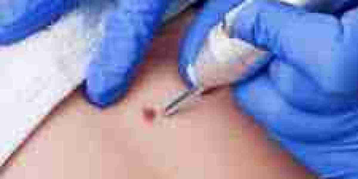 1. The Ultimate Guide to Laser Wart Removal in Dubai: Everything You Need to Know