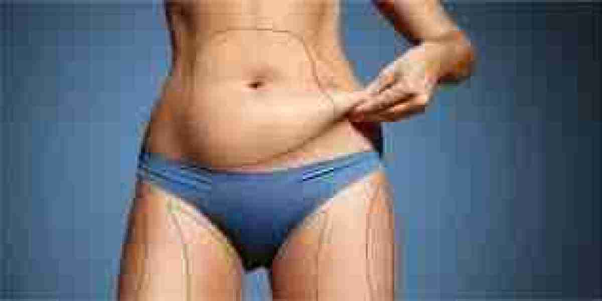 Liposuction Dubai: Liposuction Surgery in Dubai